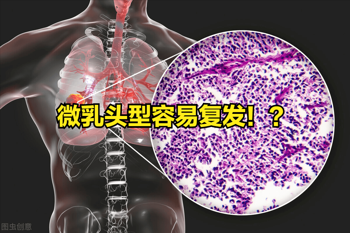 重磅揭秘，关于最新型肺癌，你需要知道的一切真相！